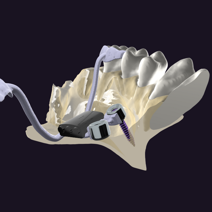 CLEAR ULTURA Aligner System